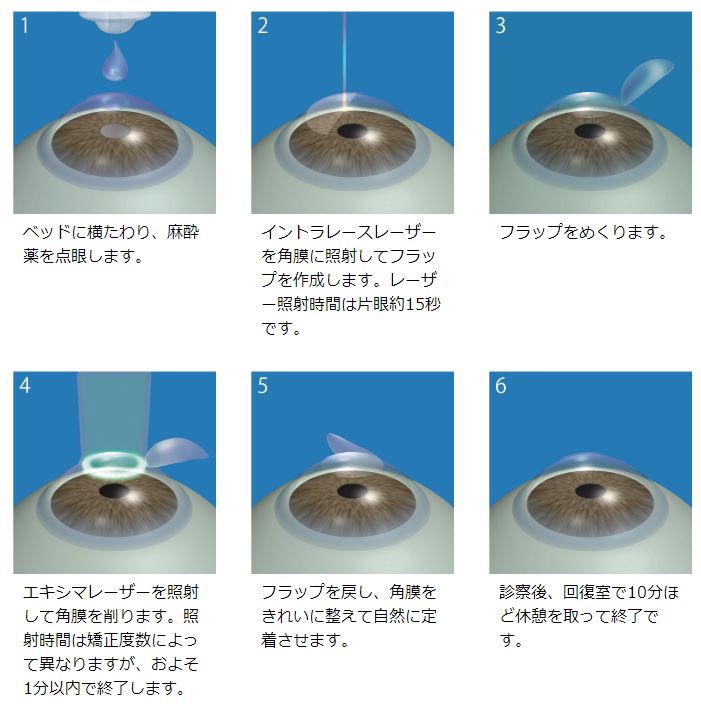 LASIK手術の流れ