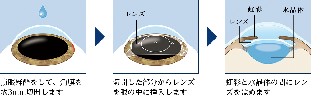 ICL手術の流れ