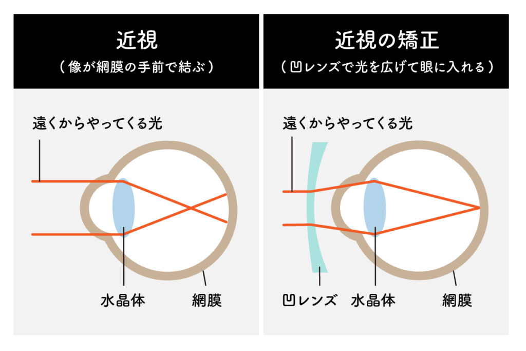 近視の矯正方法