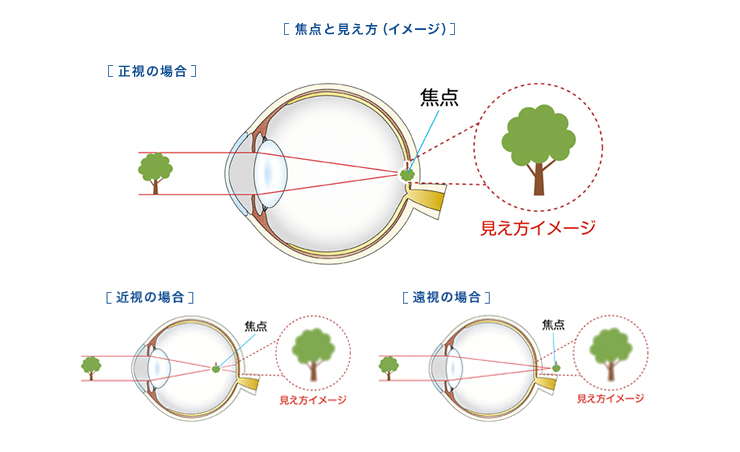 近視とは眼の中でどういう状態になっているのか